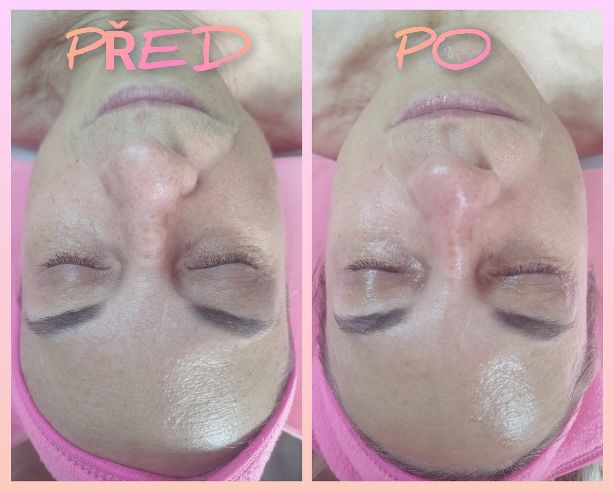 Takto vypadá pleť po první proceduře s exosomy